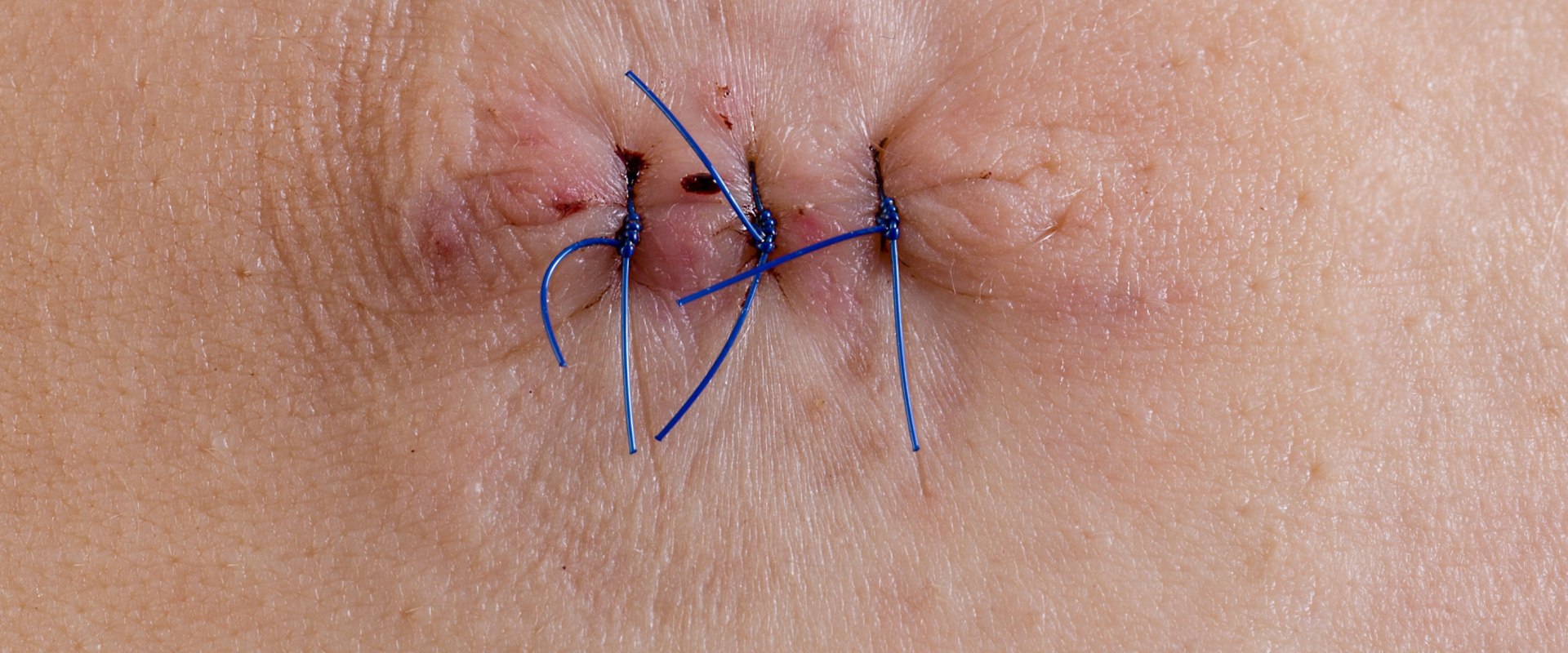 Infected Stitches Pictures You Need to See to Spot Danger