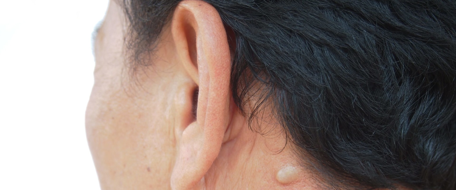 Boil vs Cyst vs Abscess: Quick Guide to Safe Care