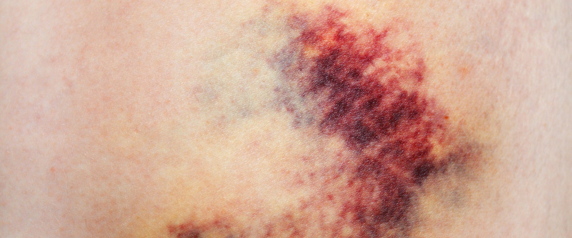 Purpura Simplex Explained What Rashes and Bruises Really Mean