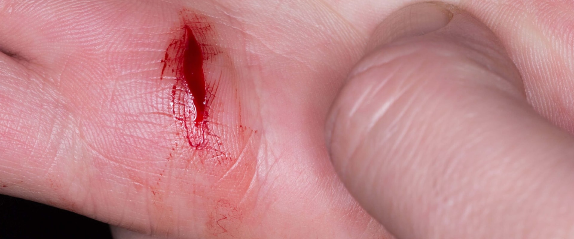 The Complete Guide to Skin Avulsion Wound on Finger Care & Healing