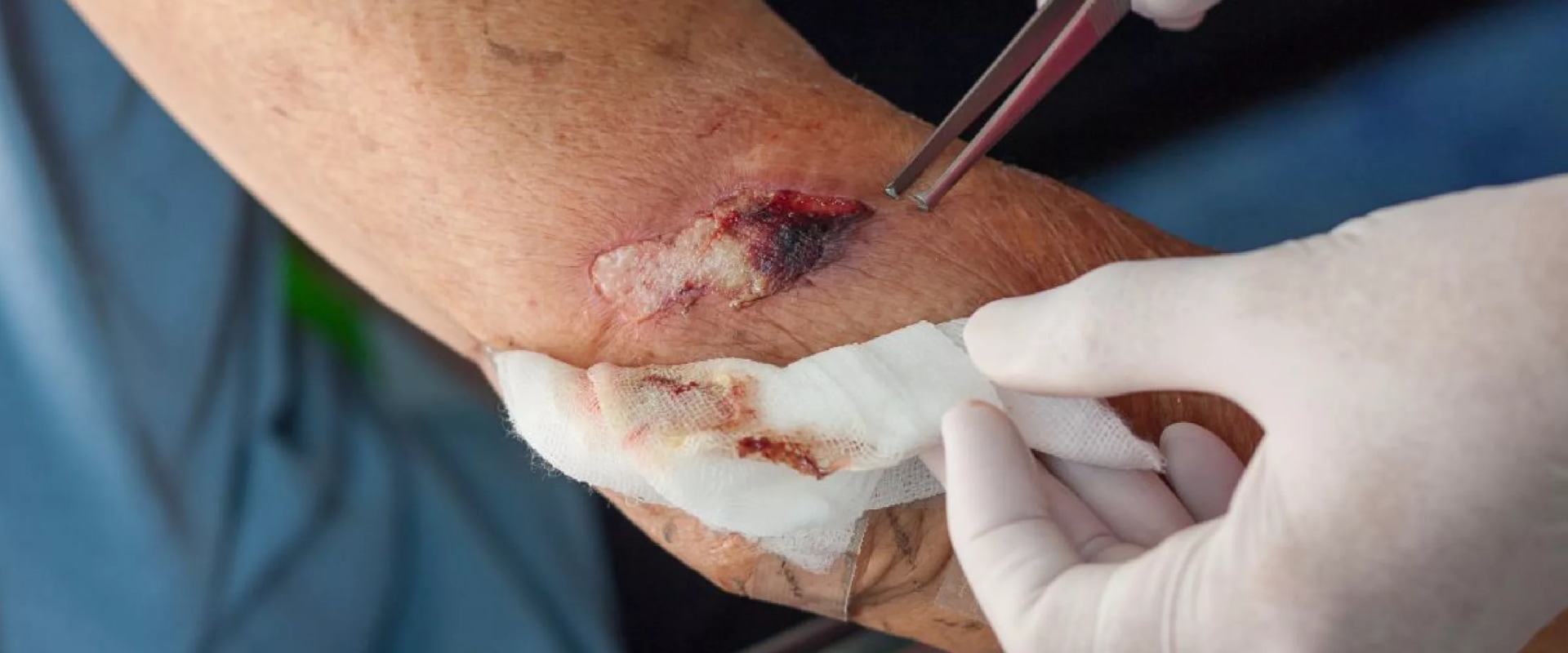 Infected Stitches Explained: Safe Treatment and Prevention