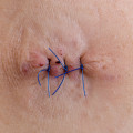 Infected Stitches Pictures You Need to See to Spot Danger