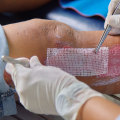 Granulation Tissue Pictures: Visual Guide to Wound Healing, Proper Care Tips, and How to Promote Faster Skin Regeneration