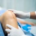Dissolvable Stitches Healing Stages: See How Recovery Unfolds