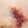 Purpura Simplex Explained What Rashes and Bruises Really Mean