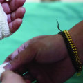 Iodoform Packing Benefits: Does It Really Speed Up Wound Healing?