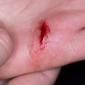 The Complete Guide to Skin Avulsion Wound on Finger Care & Healing