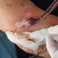 Infected Stitches Explained: Safe Treatment and Prevention