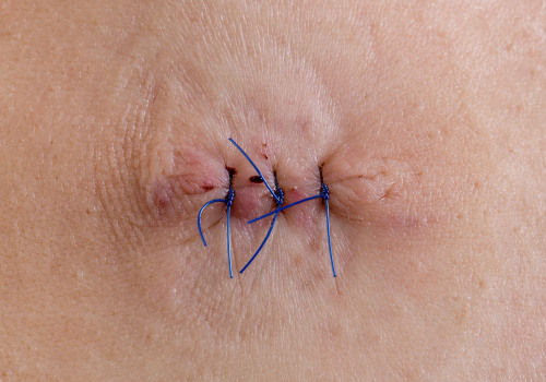 Infected Stitches Pictures You Need to See to Spot Danger