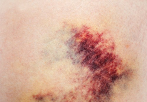 Purpura Simplex Explained What Rashes and Bruises Really Mean