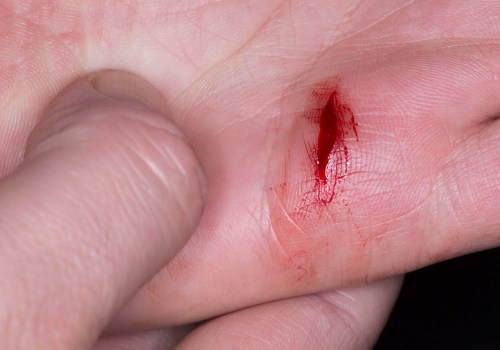 The Complete Guide to Skin Avulsion Wound on Finger Care & Healing