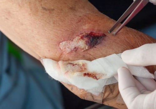 Infected Stitches Explained: Safe Treatment and Prevention